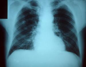 Pneumonia X-Ray by Encephalon at en.wikipedia [Public domain], from Wikimedia Commons